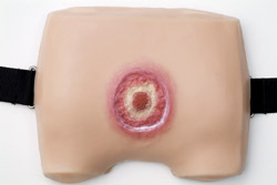 Model 6
Stage IV
Deep wound down to the muscle, bone and supporting tissue. A pocket is formed and surgery may be required